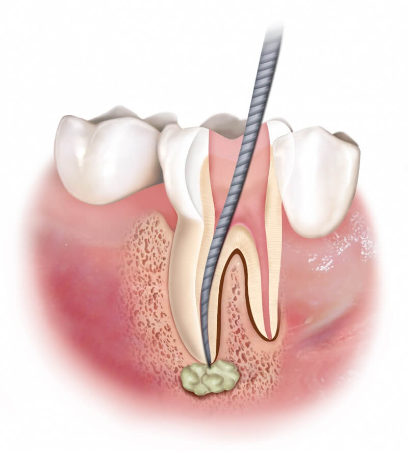 ENDODONZIA